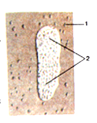 Лимфоидные узелки и лимфоидная бляшка в стенке