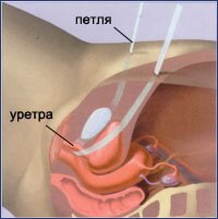 СТРЕССОВОЕ НЕДЕРЖАНИЕ МОЧИ