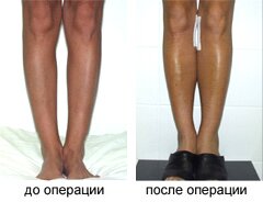 протез
